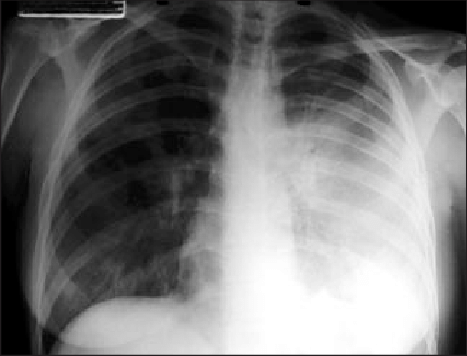Radiografía de Tórax de un Paciente con Peste Neumonica 