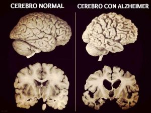 Nuevo fármaco aprobado por la FDA como tratamiento contra el Alzhéimer, ha causado polémica. 3 Nuevo fármaco aprobado por la FDA - Nuevo fármaco aprobado por la FDA