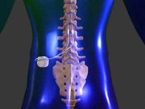 Un implante en la médula - Un implante en la médula