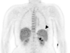 Descubren dónde se esconde la Malaria en el cuerpo 2 -