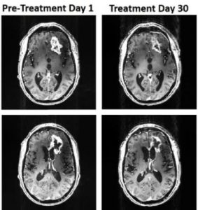 Casco magnético encoge tumor cerebral en el primer caso del mundo 1 -