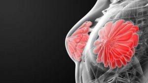 Descubren el tratamiento más eficaz contra el cáncer de mama. 4 Descubren tratamiento más eficaz - Descubren tratamiento más eficaz