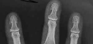 Nueva enfermedad descubierta - Nueva enfermedad descubierta