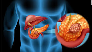 Tratamiento vs diabetes tipo 1 - Tratamiento vs diabetes tipo 1