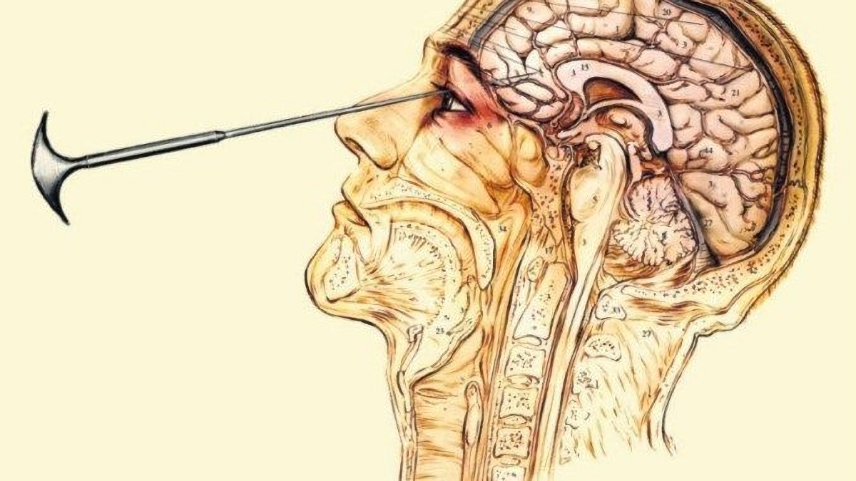 Lobotomías: la espeluznante historia del agujero en la cabeza