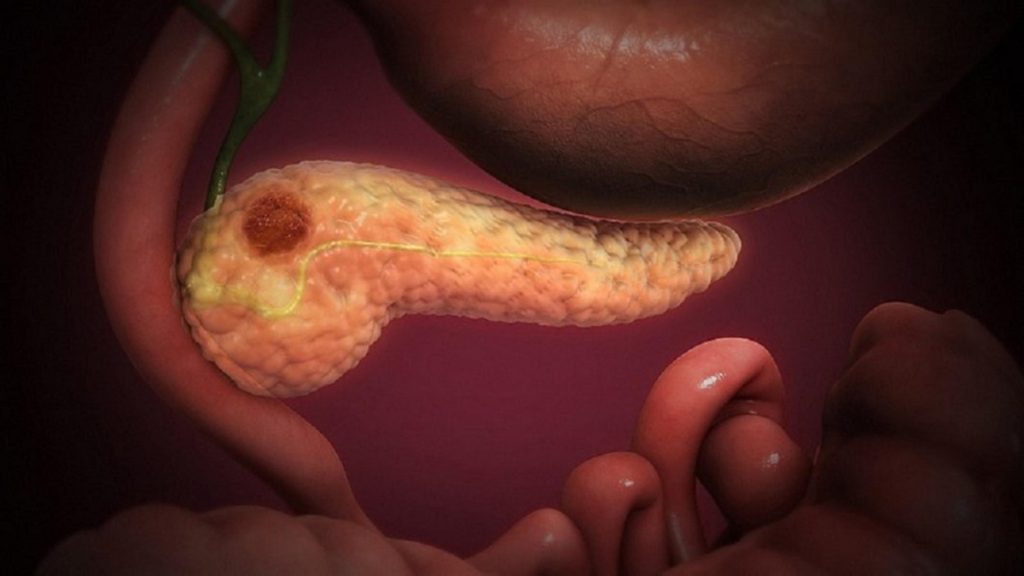 Por primera vez, una nueva terapia contra el cáncer resulta en una reducción del tumor 1 -