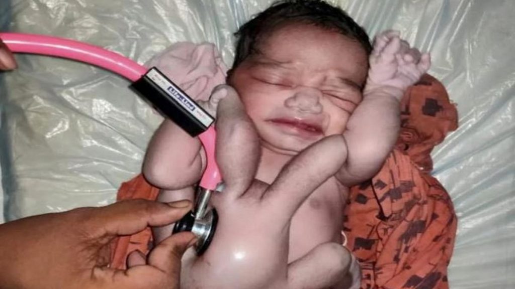 Bebé "milagroso" nacido en India con cuatro brazos y cuatro piernas 1 -