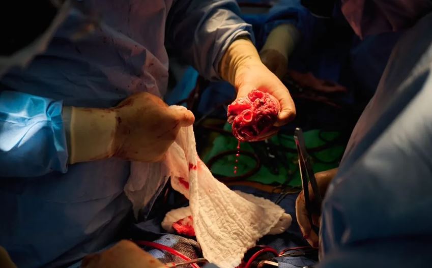 Trasplanta con éxito dos corazones de cerdo editados genéticamente a personas con muerte cerebral 3 -