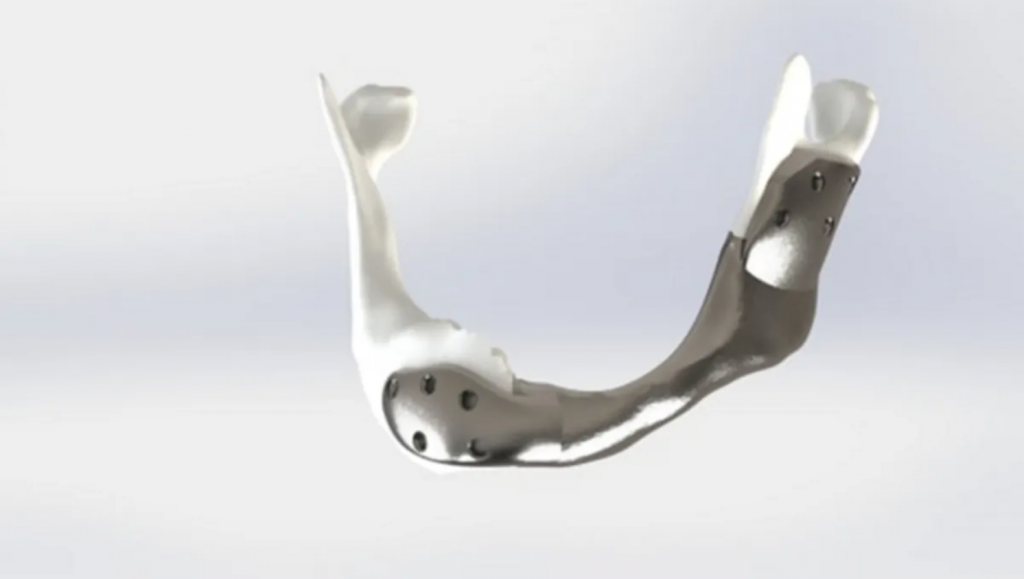 implante,3D,mandibula,cáncer - implante