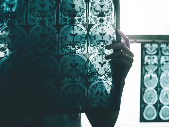 15 conceptos erróneos y realidades sorprendentes sobre la demencia y el Alzheimer 2 -