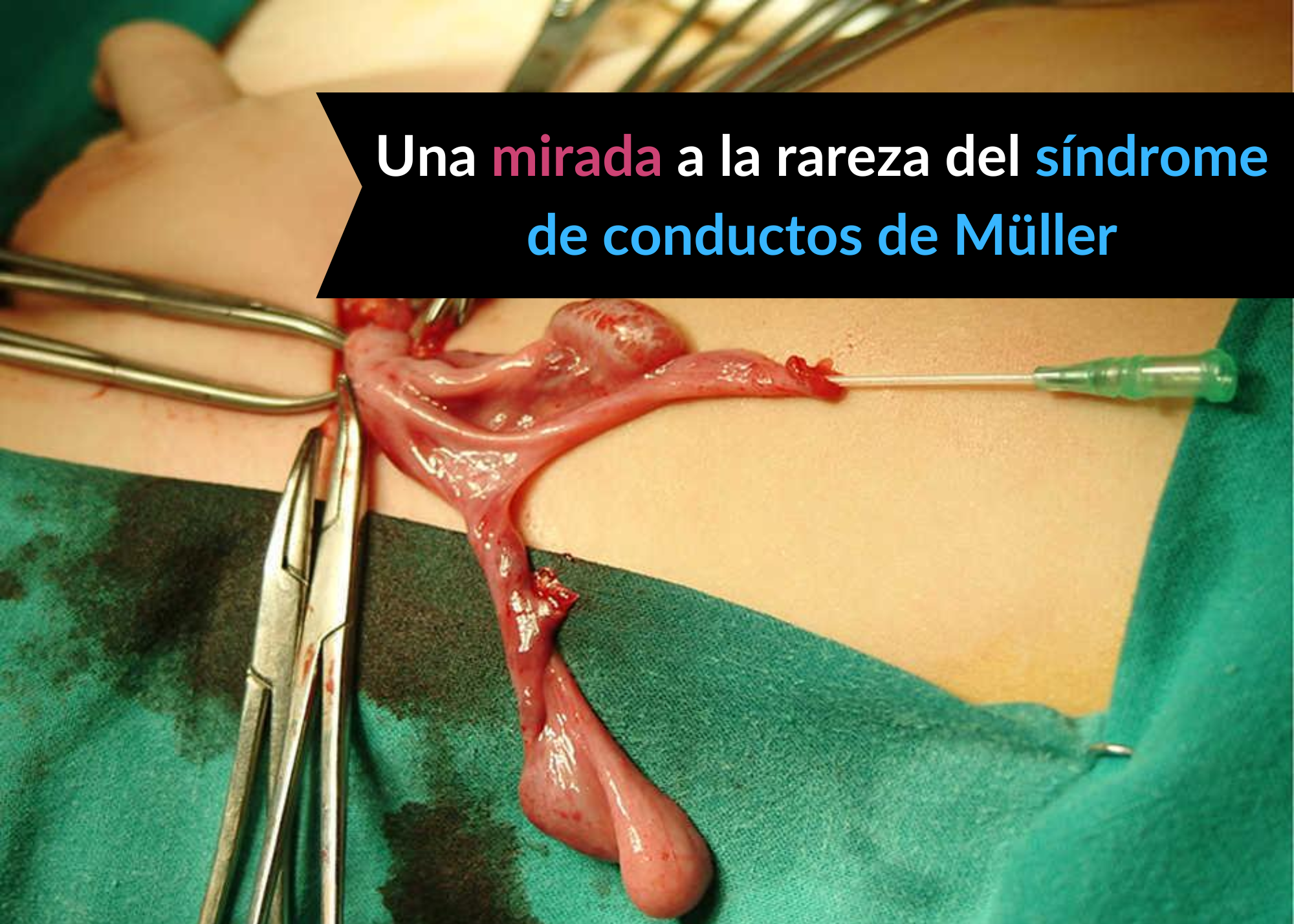 Síndrome de Conductos de Müller Persistente