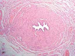 síndrome - síndrome