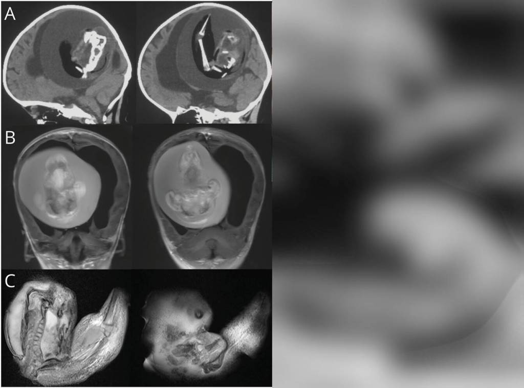 Imagen de Feto-en-Feto Tomografía computarizada de la cabeza (A) e imagen ponderada en T1 (B) de un bebé que muestra hidrocefalia, compresión cerebral y una masa intraventricular con columna vertebral, fémur y tibia. Imagen ponderada en T1 de la masa que revela bífida espinal (C). La masa fetiforme con extremidades superiores y yemas similares a los dedos (D).