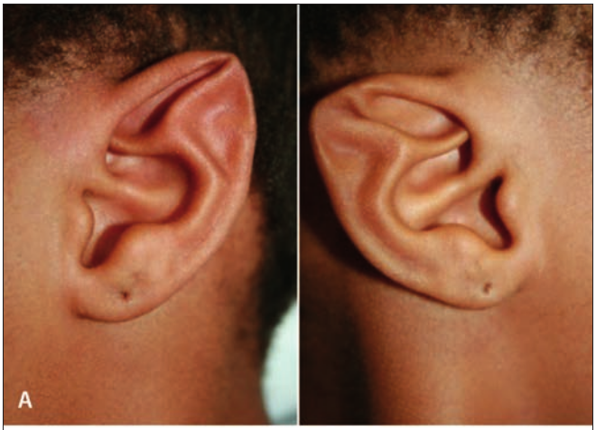 Orejas Mitológicas, una malformación congénita real conocida como la Oreja Stahl 1 Oreja Stahl - Oreja Stahl