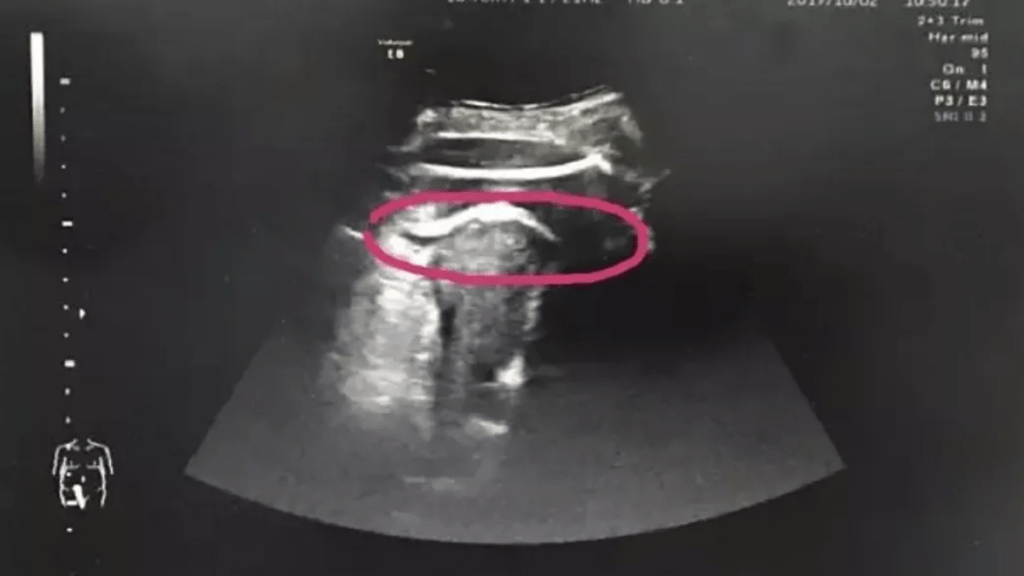 Mujer embarazada casi muere después de que su bebé pateara a través de la pared de su útero 1 -