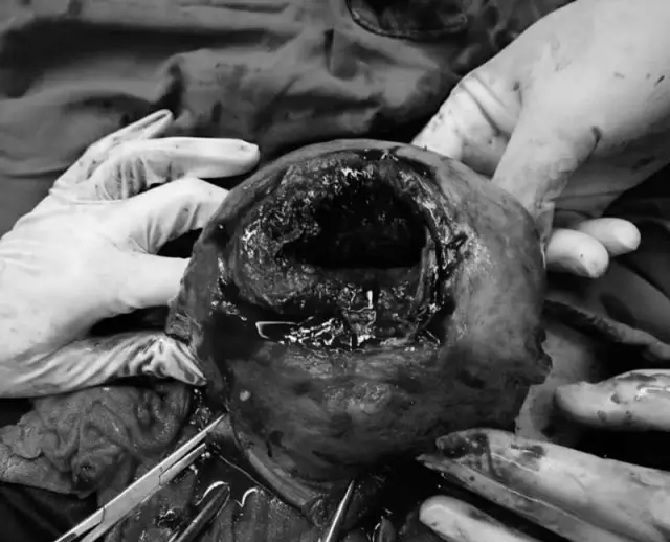 Mujer embarazada casi muere después de que su bebé pateara a través de la pared de su útero 2 -