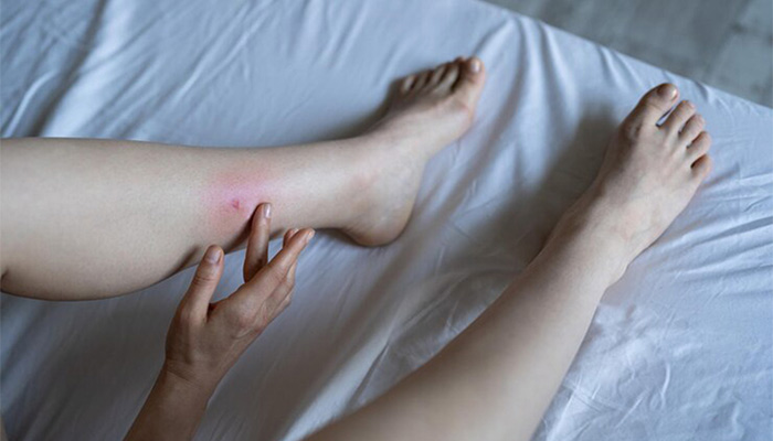 Arañas violinistas: Cómo actuar ante este peligroso insecto