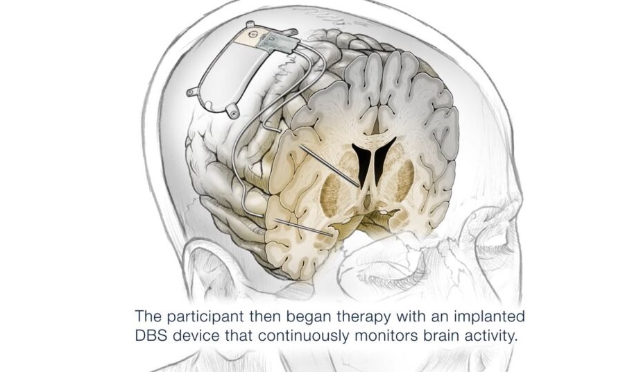 Implante cerebral para tratar la depresión severa
