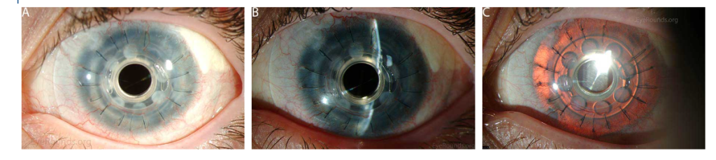 queratoprótesis - queratoprótesis