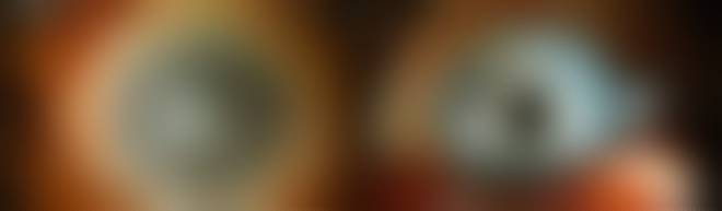 queratoprótesis - queratoprótesis