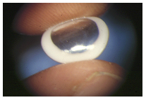 queratoprótesis - queratoprótesis