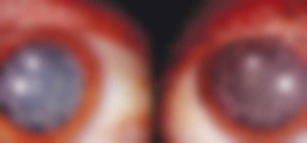 Cataratas en forma de estrellas: la extraña forma que provocó una descarga de 14,000 voltios 1 Cataratas en forma de estrellas: la extraña forma que provocó una descarga de 14,000 voltios