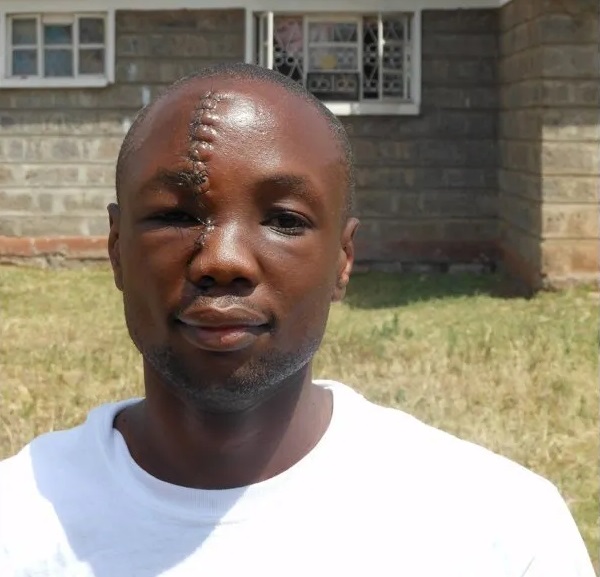 Anthony Omari: el superhéroe de la cicatriz 3 Anthony Omari: el superhéroe de la cicatriz