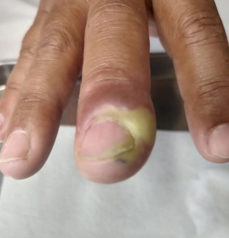 Morderse las uñas: las graves consecuencias para nuestra salud