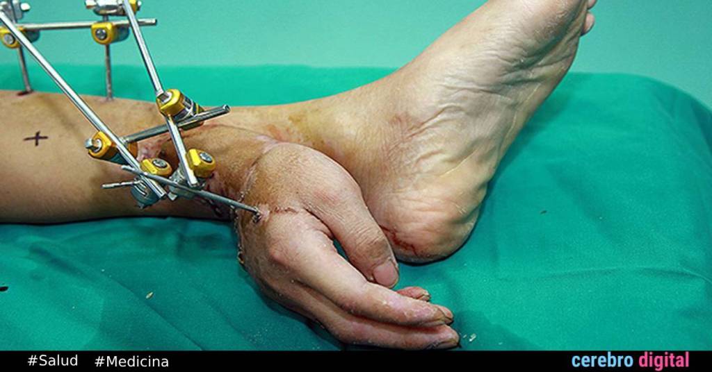 Injertar una mano en el tobillo para salvarla: uno los casos médicos más sorprendentes