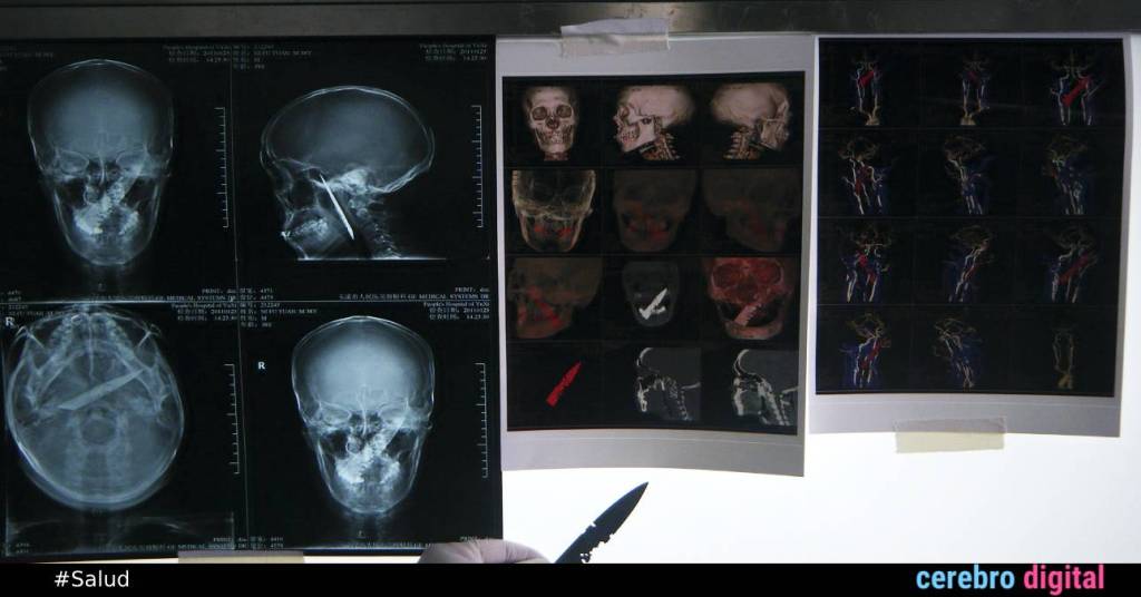 Li Fuyan: el hombre que vivió cuatro años con un cuchillo en la cabeza