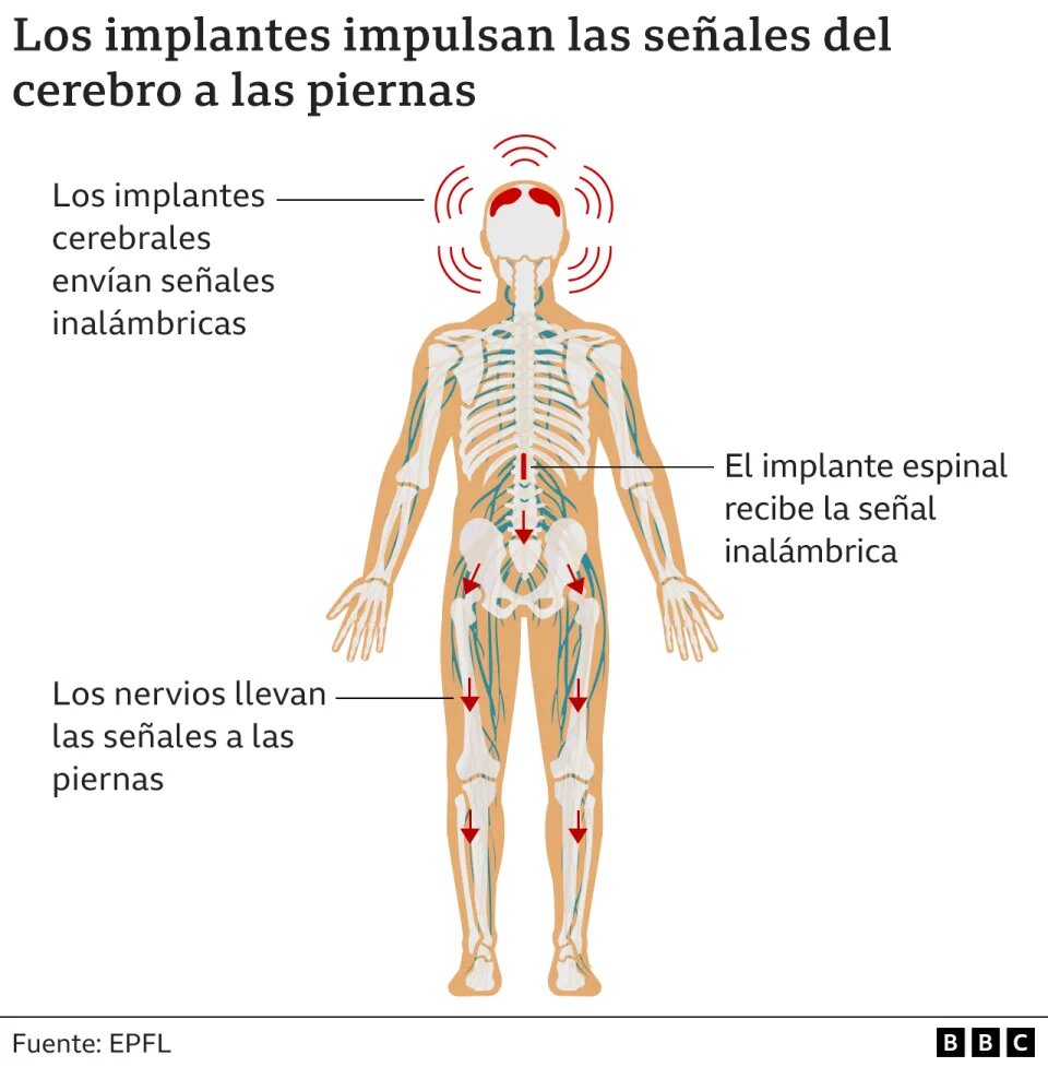 Implante cerebral hizo que un hombre volviera a caminar 12 años después