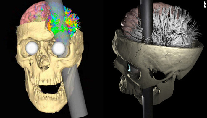 https://staging-7b2a-cerebrodigitalnet.wpcomstaging.com/wp-content/uploads/2023/10/phineas-gage-how-did-he-survive-a-steel-rod-that-pierced-and-destroyed-his-frontal-lobe-cover-1.jpg