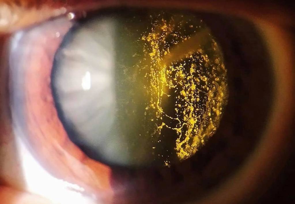 La curiosa enfermedad ocular hialosis asteroide 2 La curiosa enfermedad ocular hialosis asteroide