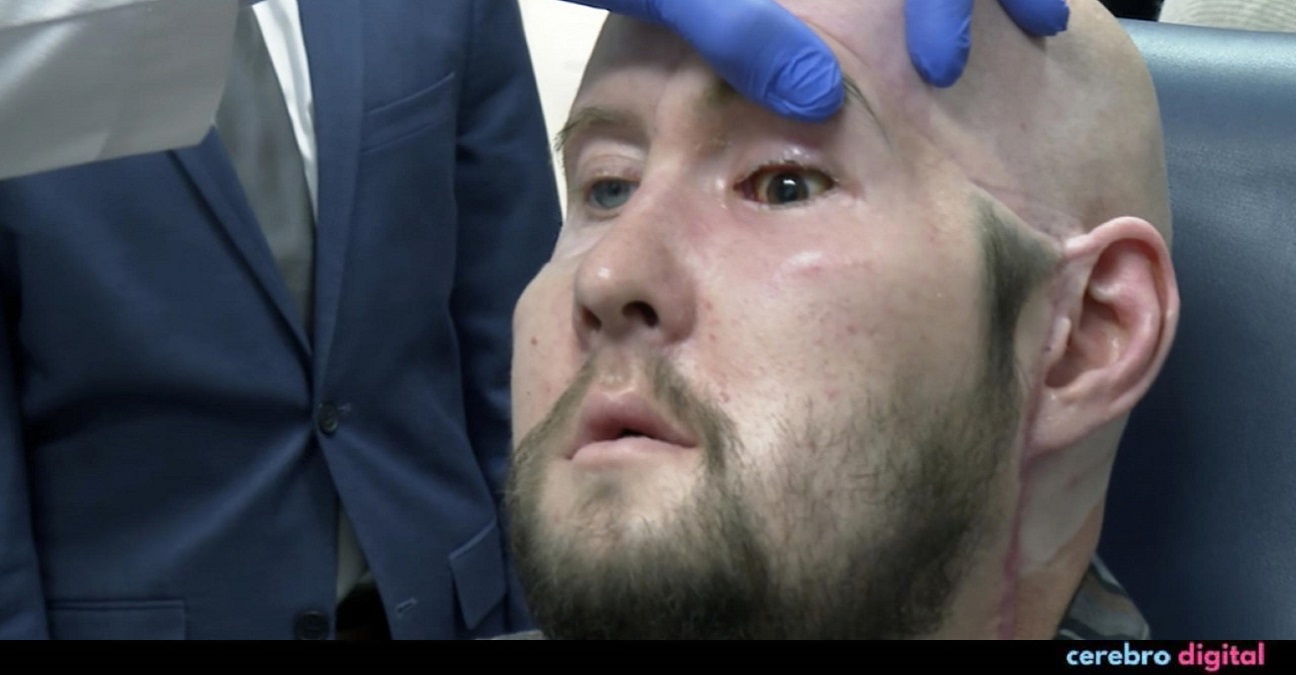 Un hombre recibe su primer trasplante de ojo completo tras perder la mitad de su rostro 1 -