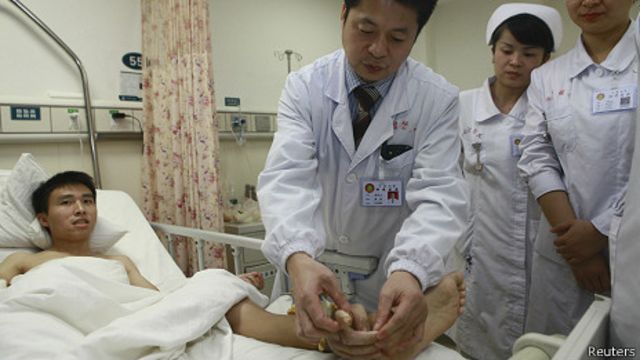 Transplanting a Hand to the Ankle to Save It: One of the Most Astonishing Medical Cases 3 Transplanting a Hand to the Ankle to Save It: One of the Most Astonishing Medical Cases