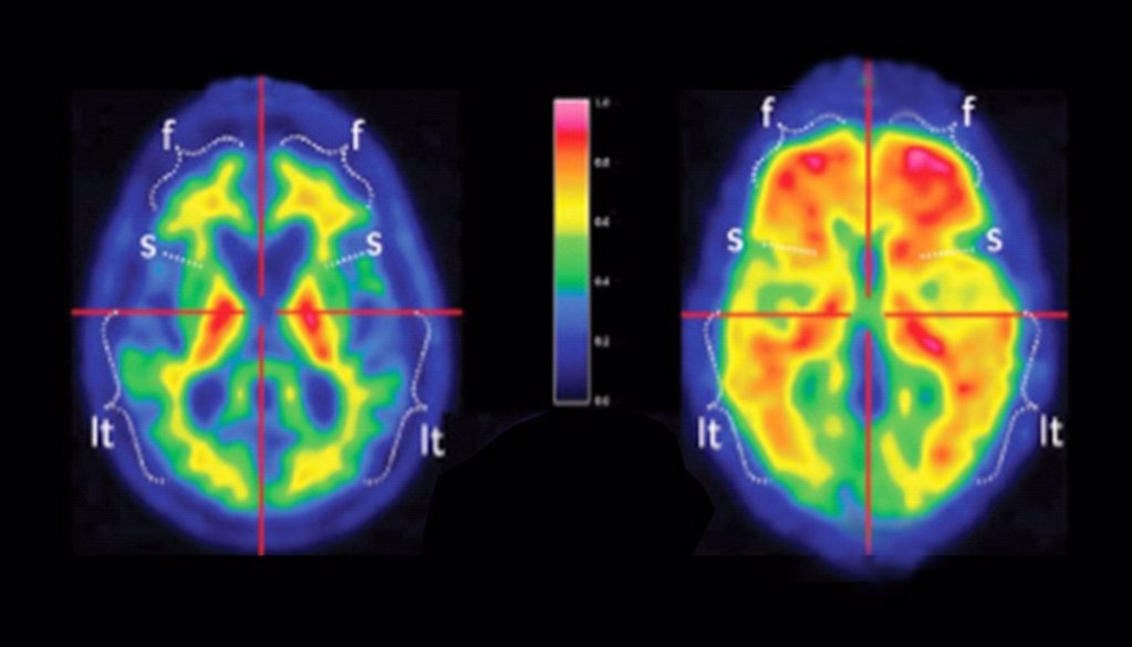 La cura del Alzheimer podría estar en una paciente colombiana 3 La cura del Alzheimer podría estar en una paciente colombiana