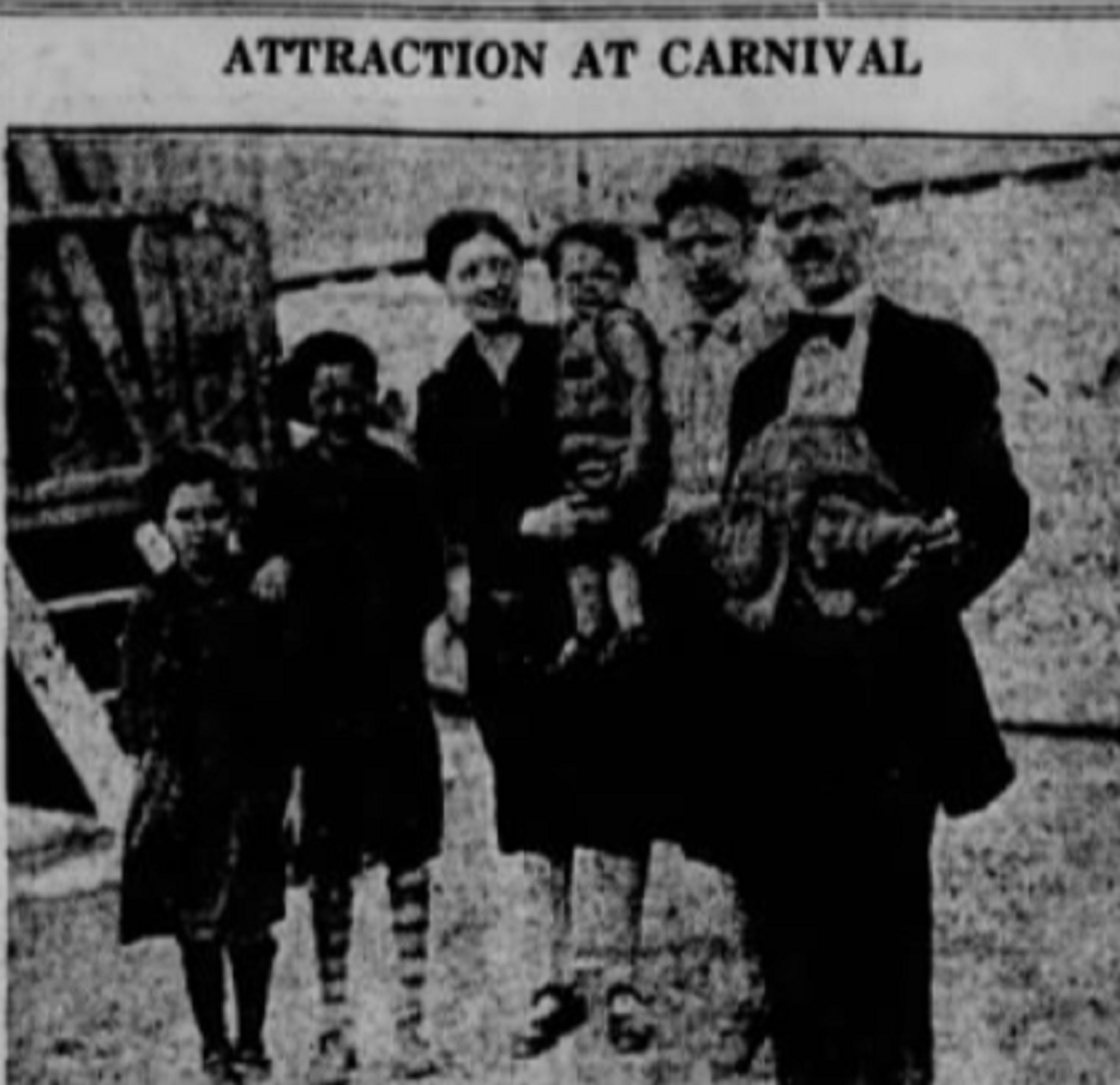 Jean Libbera: el hombre que nació con su gemelo parasitario creciendo en su abdomen