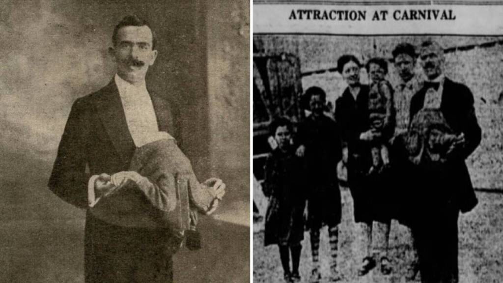 Jean Libbera: el hombre que nació con su gemelo parasitario creciendo en su abdomen