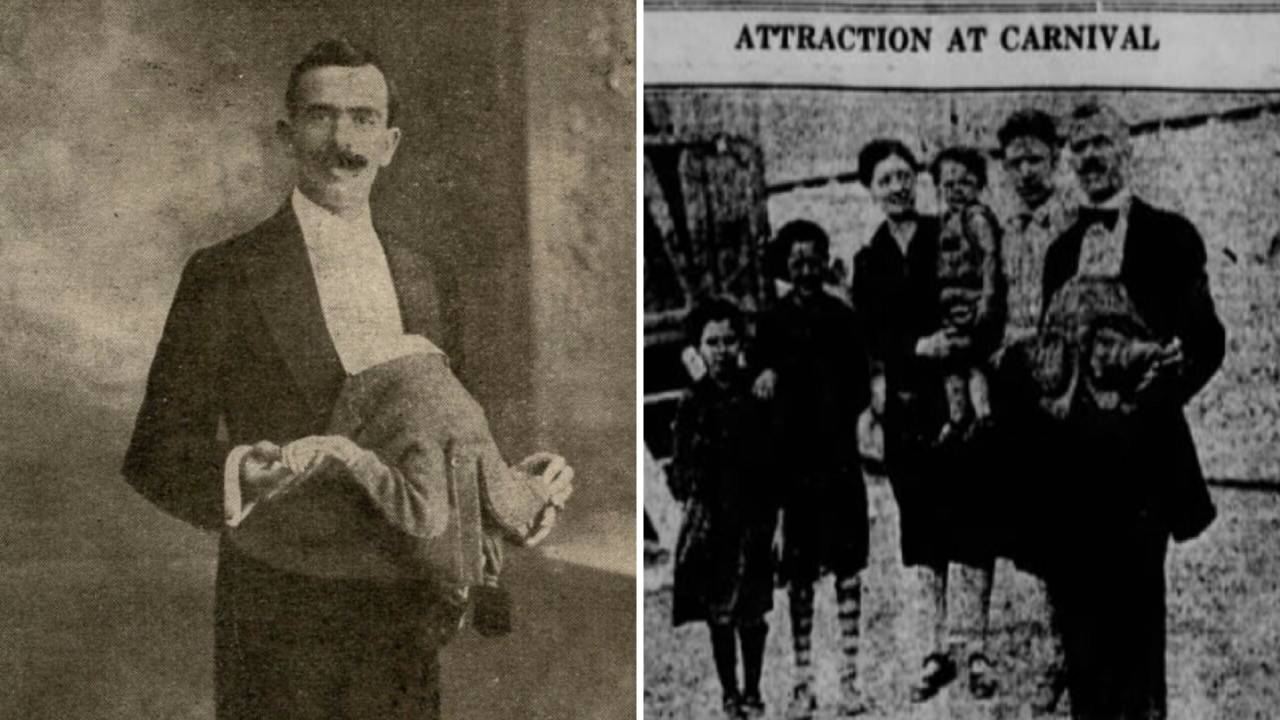 Jean Libbera: el hombre que nació con su gemelo parasitario creciendo en su abdomen