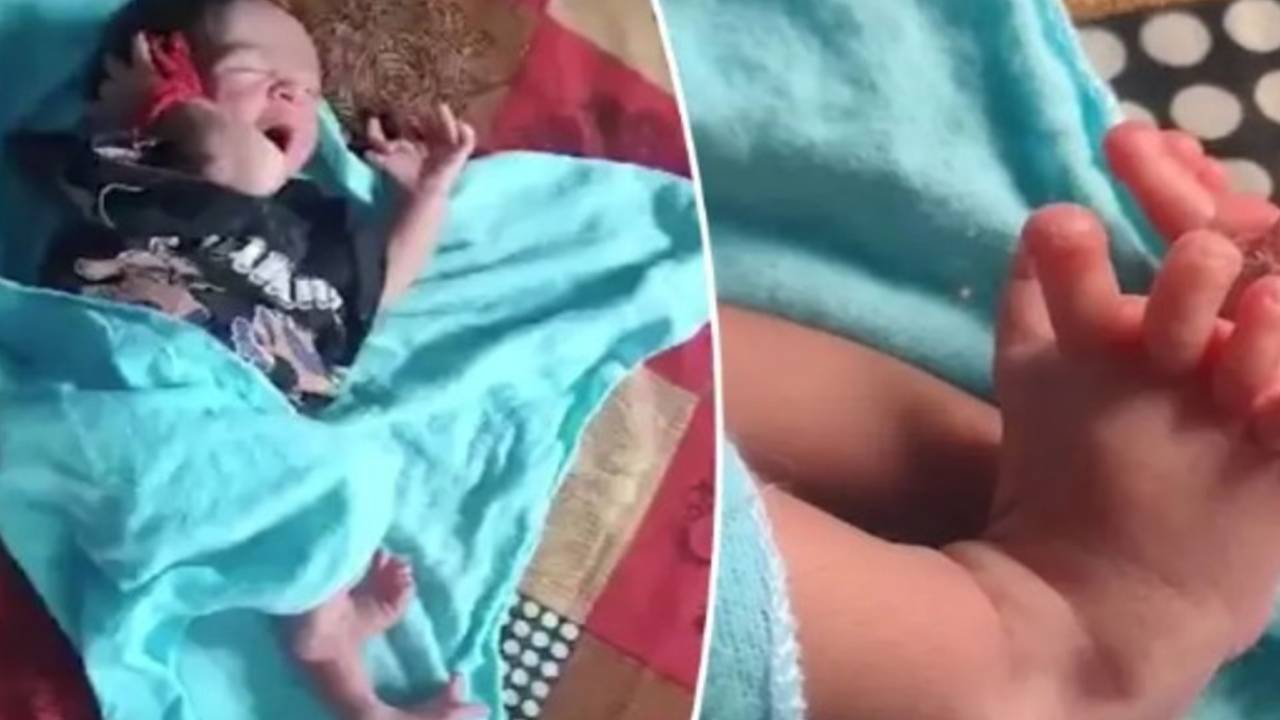 Niña nace con 26 dedos en manos y pies: Un extraño caso de polidactilia