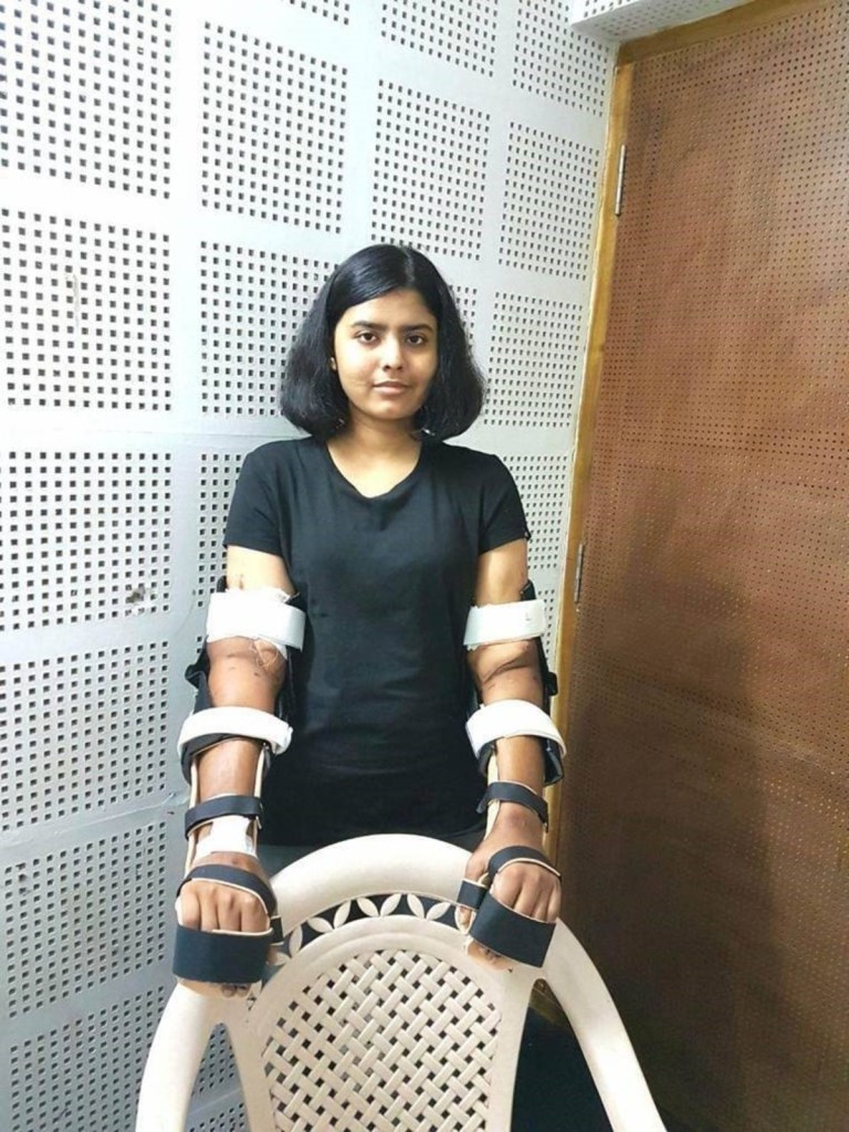 The case of Shreya Siddanagowda: A man's arm transplant adapting to her female body