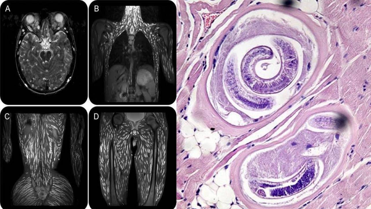 Descubre la Triquinosis: cuando una persona se infecta con gusanos parásitos por comer carne de cerdo cruda