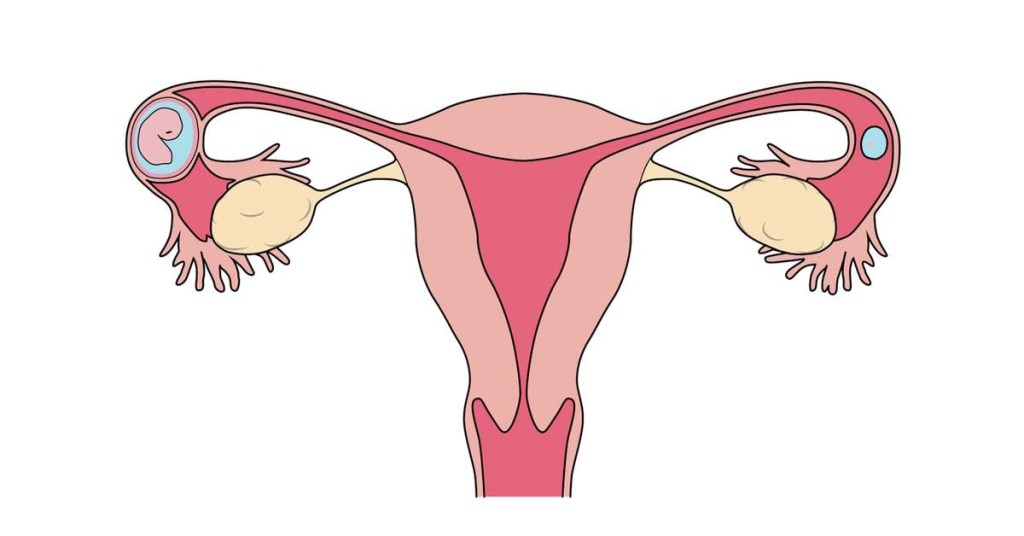 embarazo ectopico en trompa de falopio