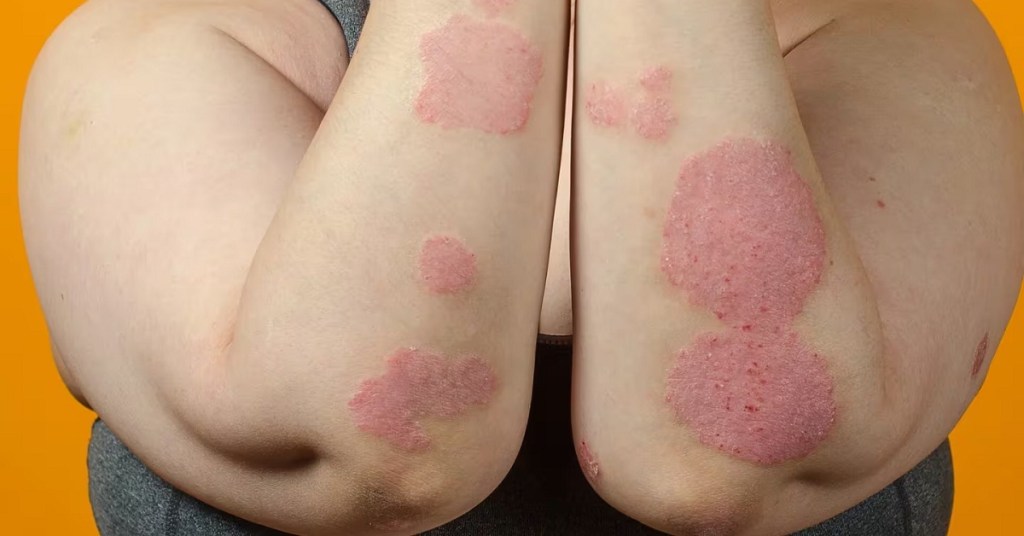 Estudio revela por qué las mujeres son más propensas a padecer enfermedades autoinmunes 1 mujer-victima-de-las-enfermedades-autoinmunes