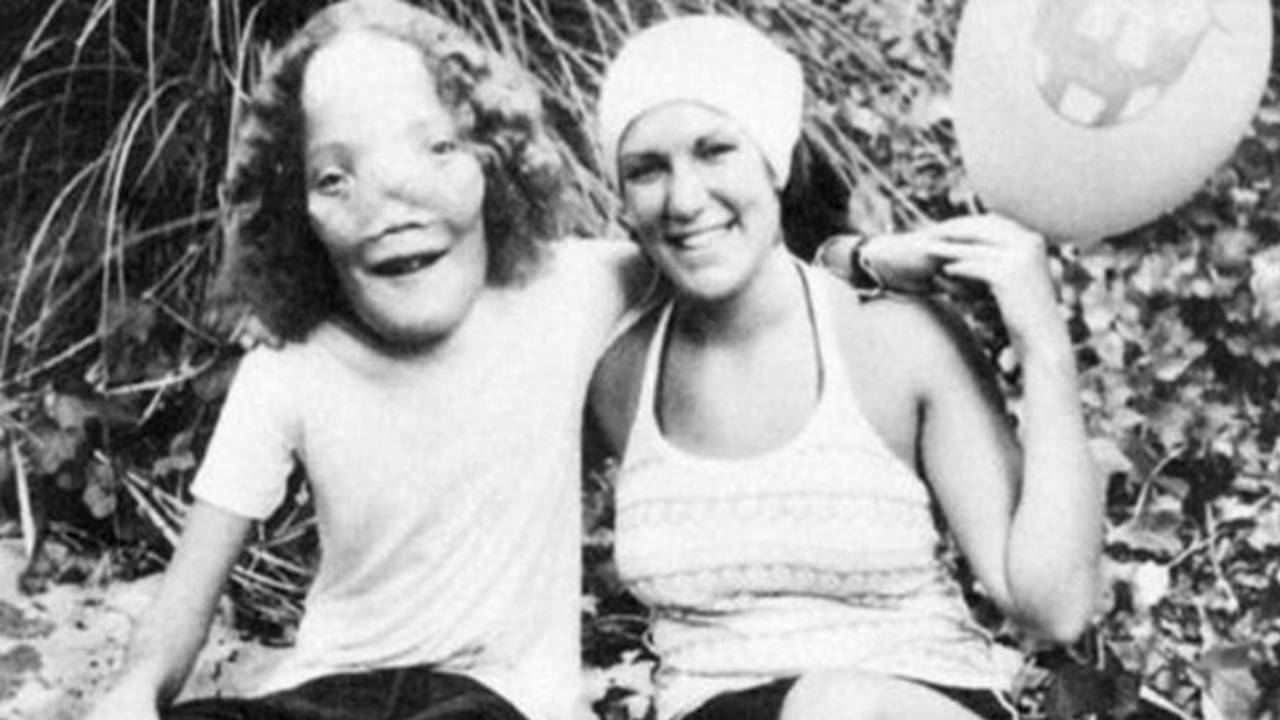 Rocky Dennis: la vida de un niño con una extraña deformidad