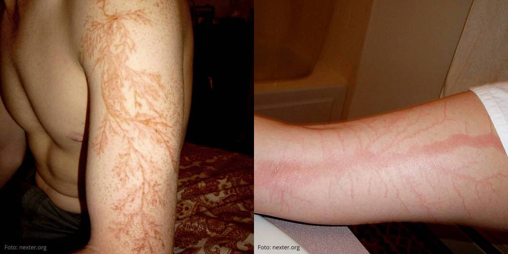 Las figuras de Lichtenberg: Lo que le sucede a tu cuerpo si te cae un rayo