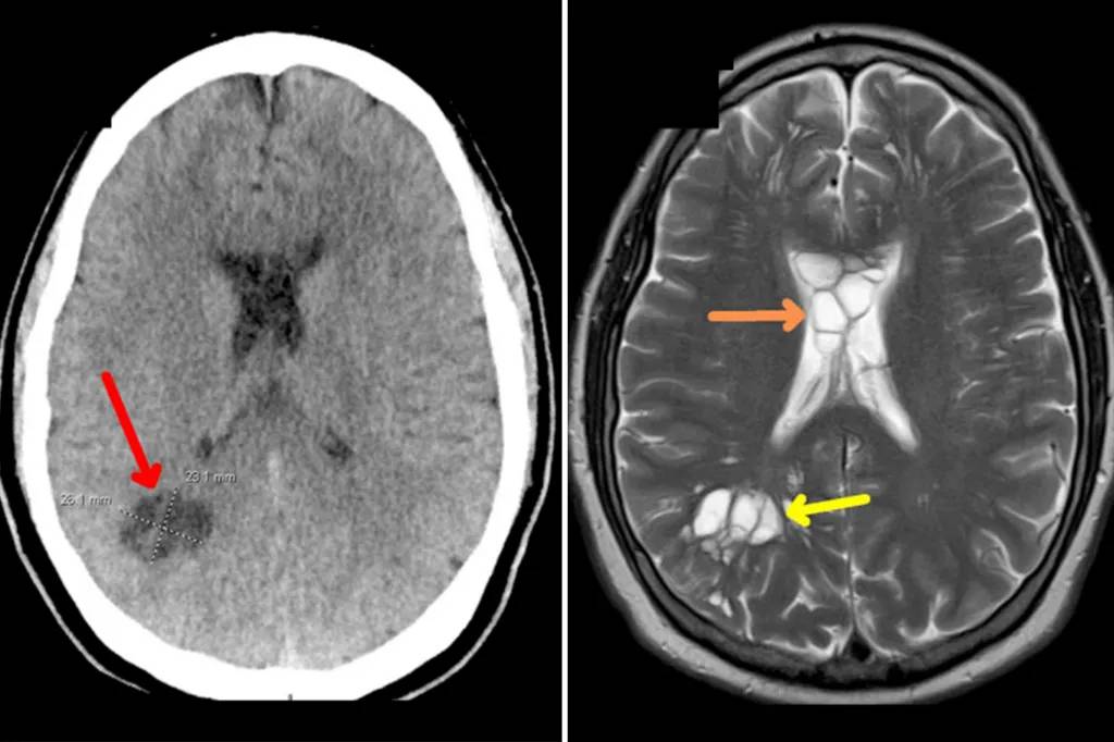 Larvas de Tenia en el cerebro: Los riesgos asociados al tocino poco cocinado 2 tenia - tenia