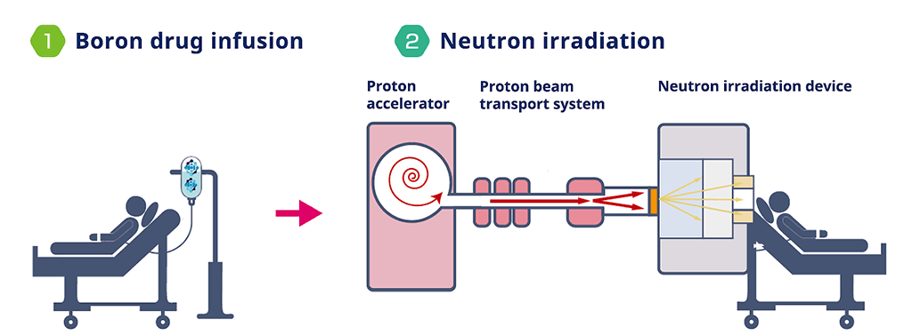 Japón es pionero en un nuevo tratamiento de radiación contra el cáncer 2 Japón es pionero en un nuevo tratamiento de radiación contra el cáncer