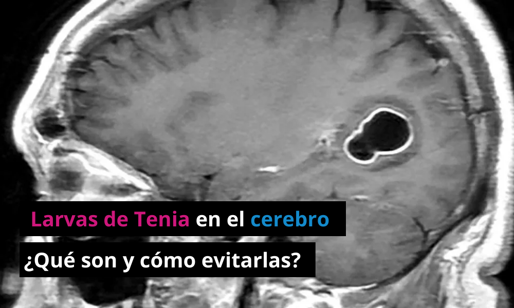 Larvas de Tenia en el cerebro
