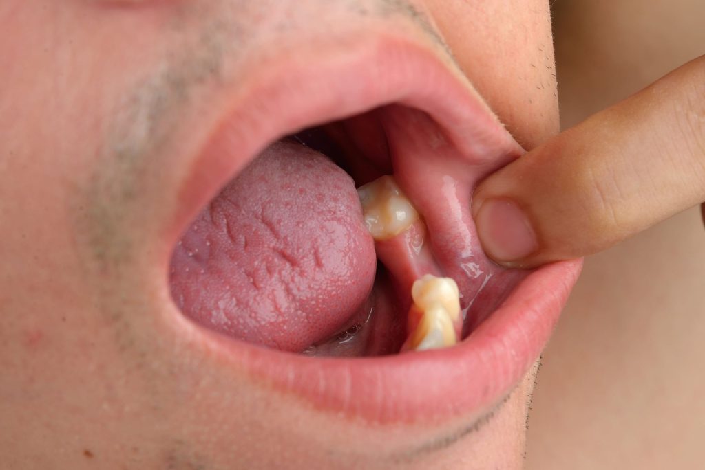 El primer medicamento para la regeneración y crecimiento de dientes se probará en septiembre 3 El primer medicamento para la regeneración y crecimiento de dientes se probará en septiembre